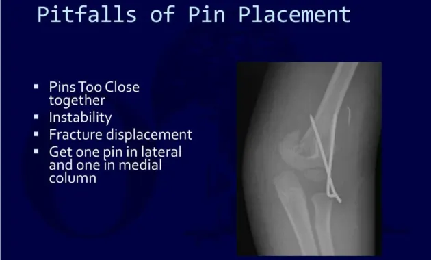 PPT - PEDIATRIC SUPRACONDYLAR HUMERUS FRACTURE PowerPoint Presentation